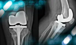 Complication case - Knee pain 6 months after a TKA