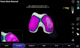 TKA robotic workflow using the CORI Surgical System