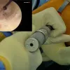 Knee anterolateral ligament reconstruction with a knotless soft anchor