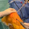 ACL remnant preservation using inside out femoral tunnel creation