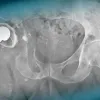 Complex hip revision in a patient with massive massive loss bone stock