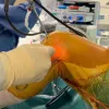 Arthroscopic anatomical PLC and PCL reconstruction using a knotless anchor: A simplified approach