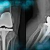 Complication case - Knee pain 6 months after a TKA